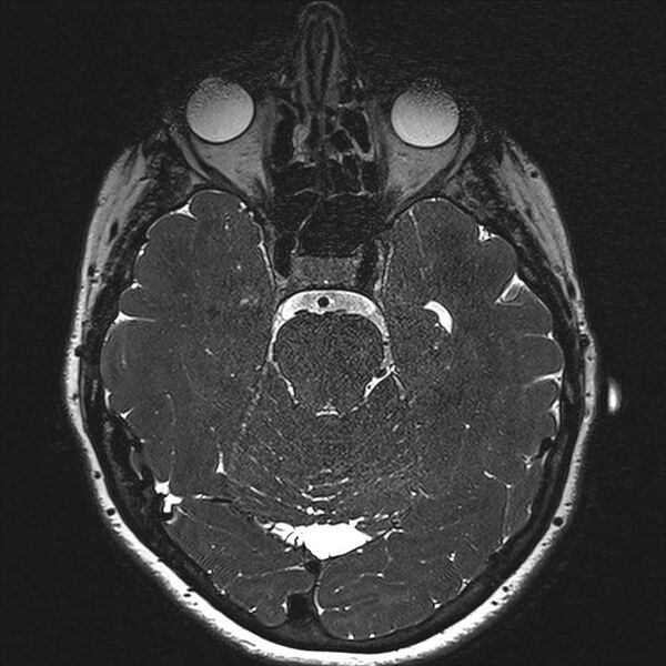 File:Anterior temporal encephalocele (Radiopaedia 82624-96808 Axial T2 high res 65).jpg