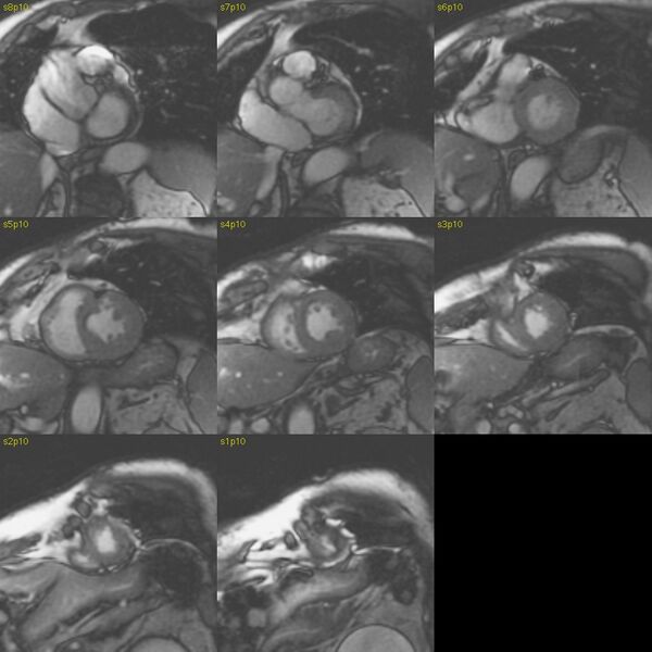 File:Anteroseptal hypokinesia after myocardial infarction (Radiopaedia 15978-15633 E 22).jpg