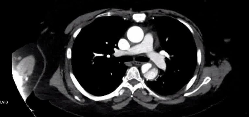 Aortic Dissection (Radiopaedia 85272-100847 A 19).jpg