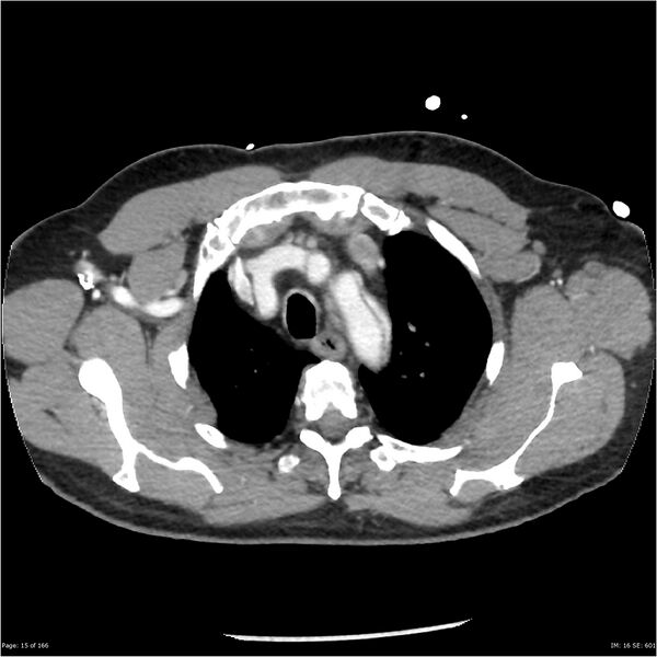 File:Aortic dissection- Stanford A (Radiopaedia 37759-39664 A 6).jpg