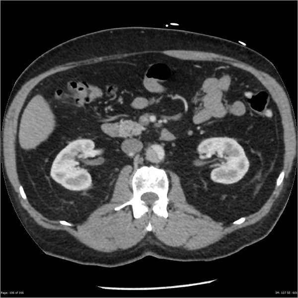 File:Aortic dissection- Stanford A (Radiopaedia 37759-39664 A 97).jpg