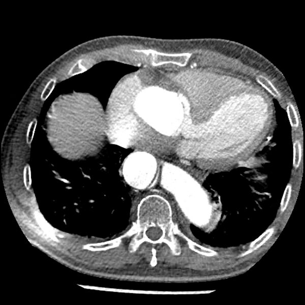 File:Aortic dissection - DeBakey Type I-Stanford A (Radiopaedia 79863-93115 A 28).jpg