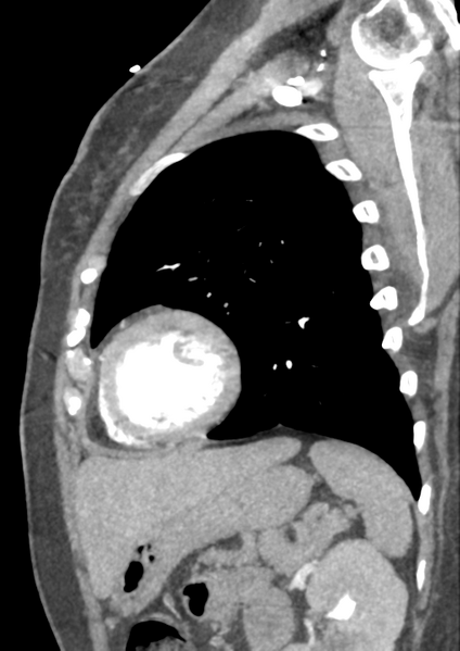File:Aortic dissection - Stanford type B (Radiopaedia 50171-55512 C 2).png