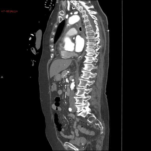 File:Aortic intramural hematoma (Radiopaedia 27746-28001 C 29).jpg