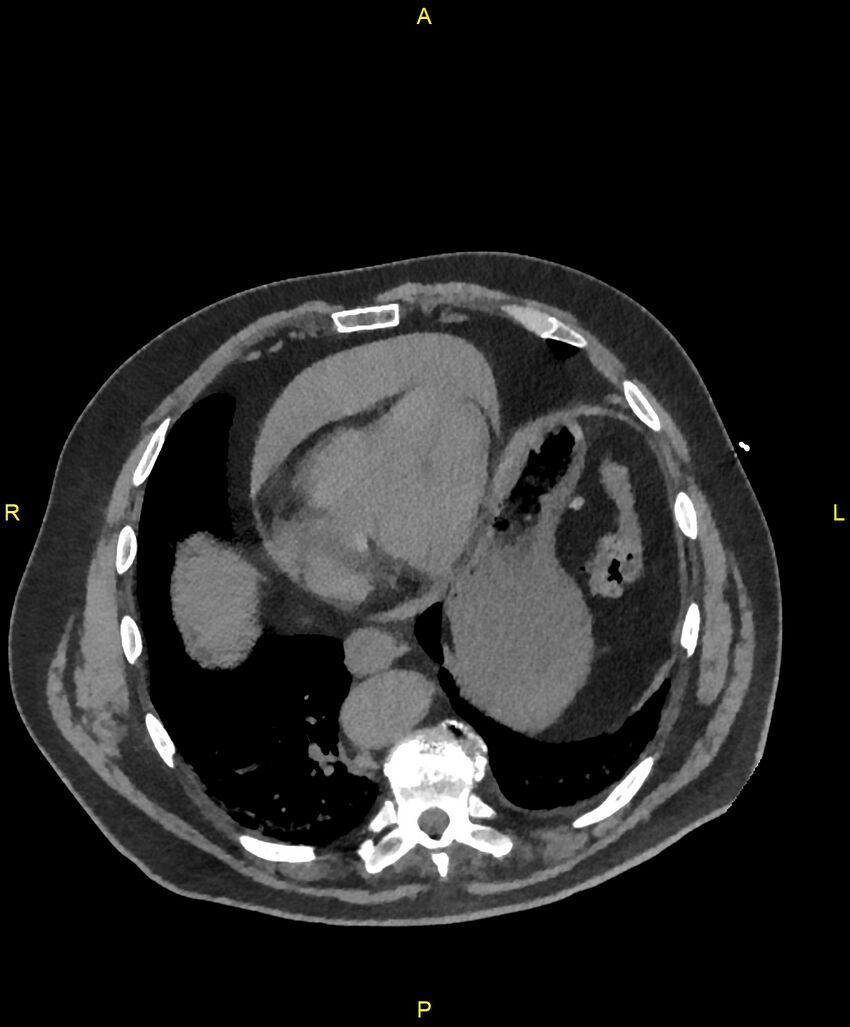 Aortic rupture (Radiopaedia 88822-105594 Axial non-contrast 170).jpg
