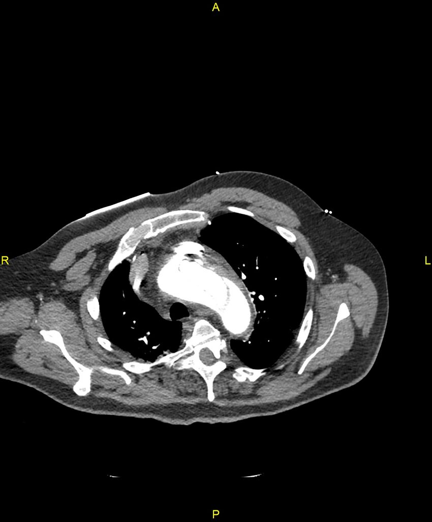 Aortic rupture (Radiopaedia 88822-105594 B 61).jpg