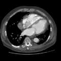 Aorto-coronary bypass graft aneurysms (Radiopaedia 40562-43157 A 80).png