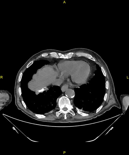 File:Aortoenteric fistula (Radiopaedia 84308-99603 Axial non-contrast 8).jpg