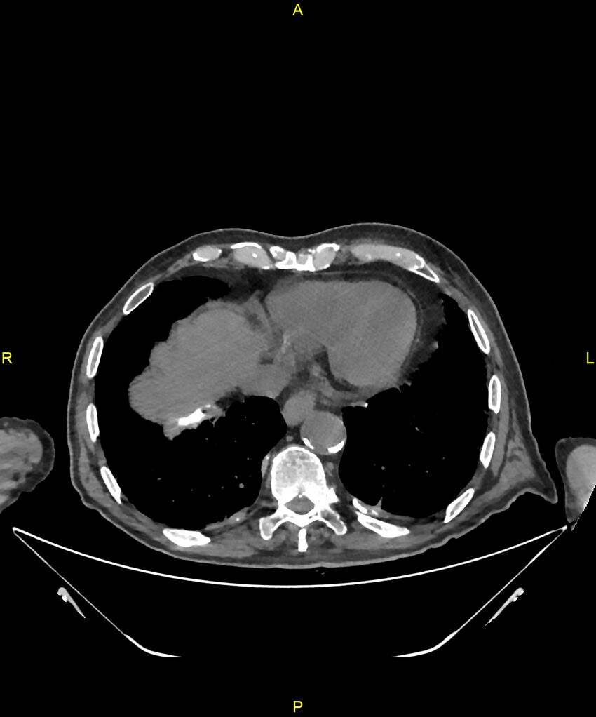 Aortoenteric fistula (Radiopaedia 84308-99603 Axial non-contrast 8).jpg