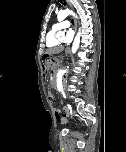 File:Aortoenteric fistula (Radiopaedia 84308-99603 C 200).jpg