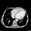 Aortopulmonary window, interrupted aortic arch and large PDA giving the descending aorta (Radiopaedia 35573-37074 B 63).jpg