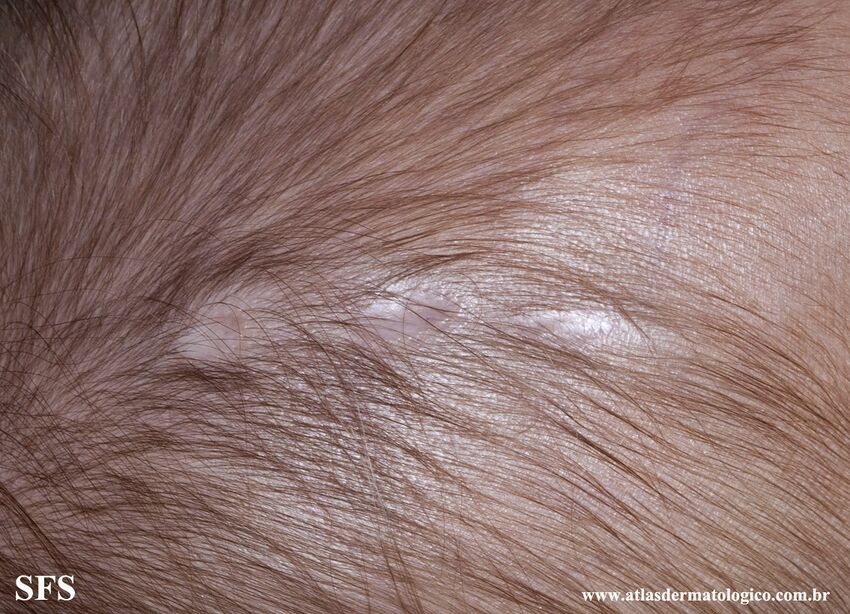 Aplasia Cutis Congenita (Dermatology Atlas 9).jpg