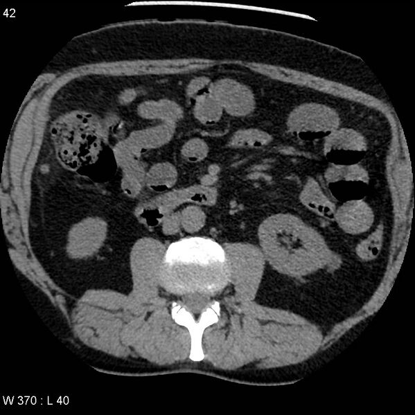 File:Appendicitis (Radiopaedia 12510-12733 Axial non-contrast 9).jpg