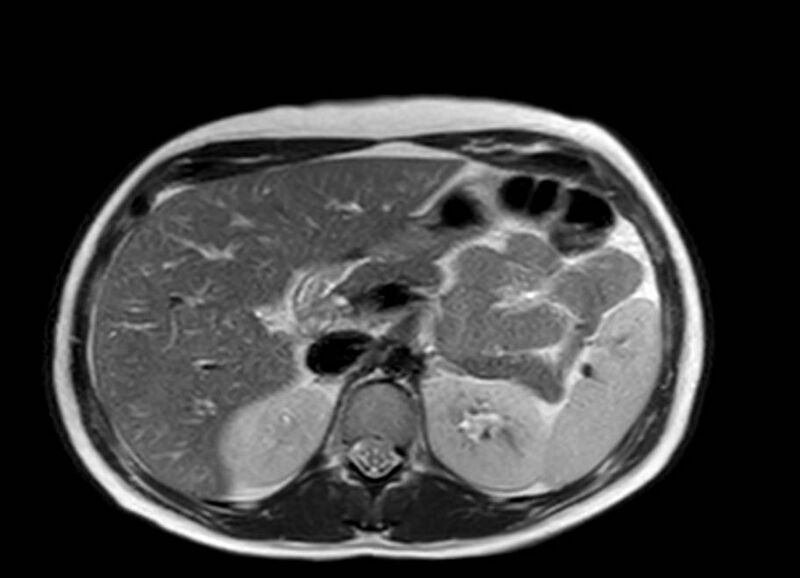 File:Appendicitis in gravida (MRI) (Radiopaedia 89433-106395 Axial T2 17).jpg