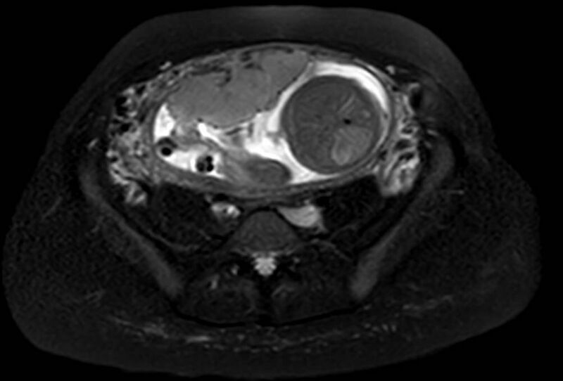 File:Appendicitis in gravida (MRI) (Radiopaedia 89433-106395 Axial T2 SPAIR 52).jpg