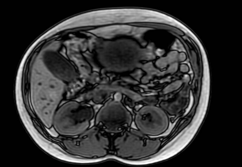 File:Appendicitis in gravida (MRI) (Radiopaedia 89433-106395 D 24).jpg