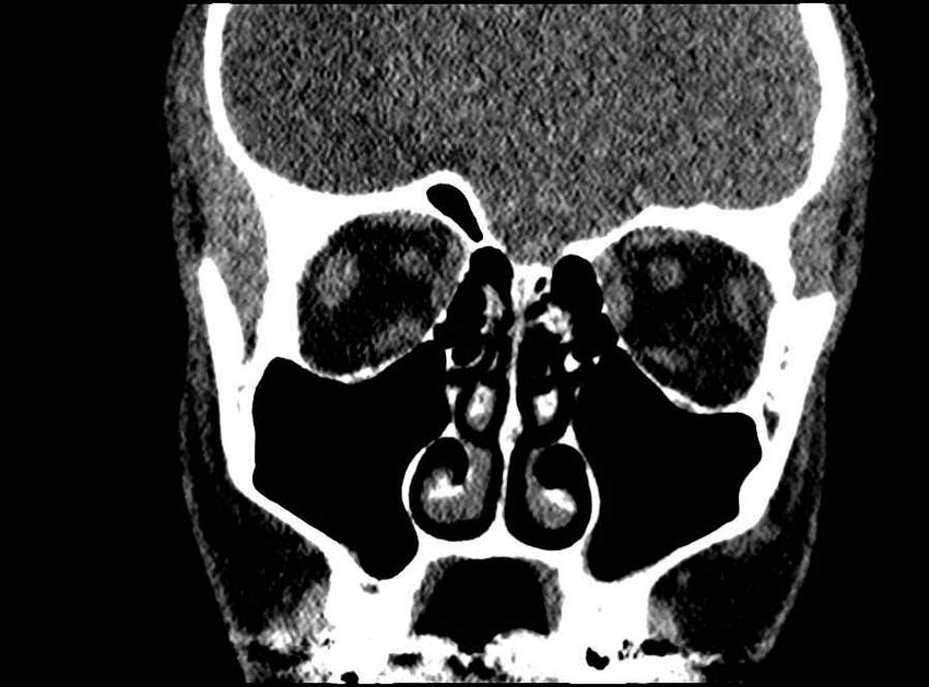 Arachnoid cyst- extremely large (Radiopaedia 68741-78450 Coronal bone window 49).jpg