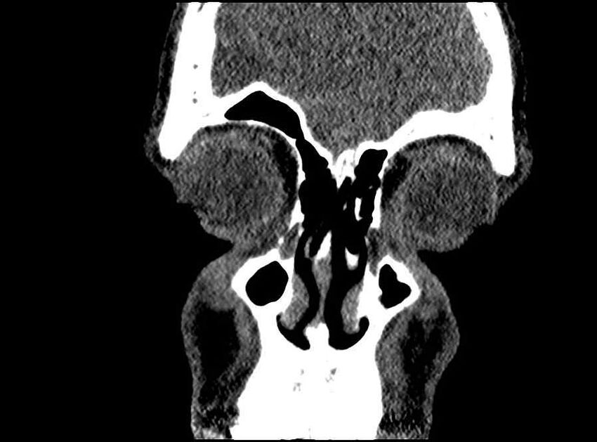 Arachnoid cyst- extremely large (Radiopaedia 68741-78450 Coronal bone window 65).jpg