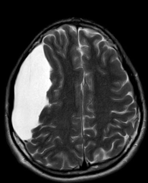 File:Arachnoid cyst- extremely large (Radiopaedia 68741-78451 Axial T2 19).jpg