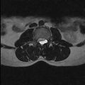 Arachnoid cyst - spinal (Radiopaedia 66835-76157 Axial T2 17).jpg