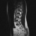 Arachnoid cyst - spinal (Radiopaedia 66835-76157 Sagittal T2 2).jpg