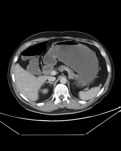 File:Arterial occlusive mesenteric ischemia (Radiopaedia 84641-100054 A 34).jpg