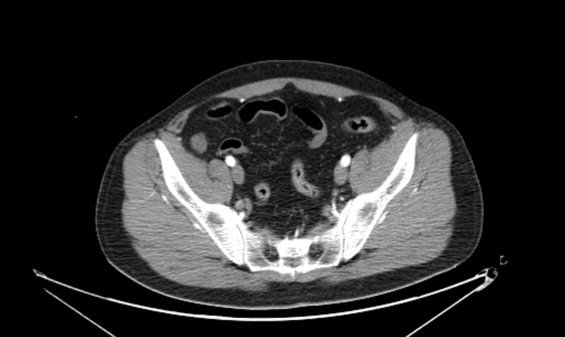 File:Arterial occlusive mesenteric ischemia (Radiopaedia 84641-100060 A 107).jpg