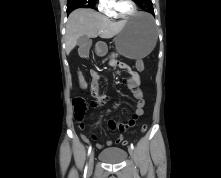File:Arterial occlusive mesenteric ischemia (Radiopaedia 84641-100060 B 21).jpg