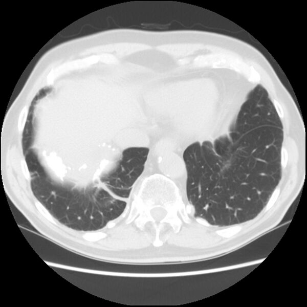 File:Asbestos-related pleural plaques (Radiopaedia 39069-41255 Axial lung window 58).jpg