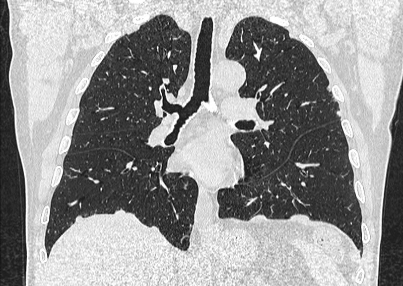 File:Asbestos pleural placques (Radiopaedia 57905-64872 Coronal lung window 153).jpg