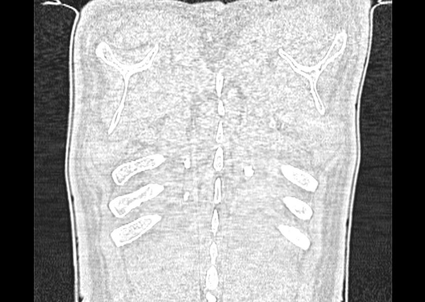 Asbestos pleural placques (Radiopaedia 57905-64872 Coronal lung window 286).jpg