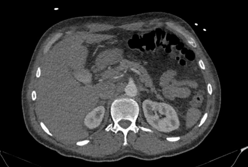 File:Ascending aortic aneurysm (Radiopaedia 86279-102297 C 72).jpg