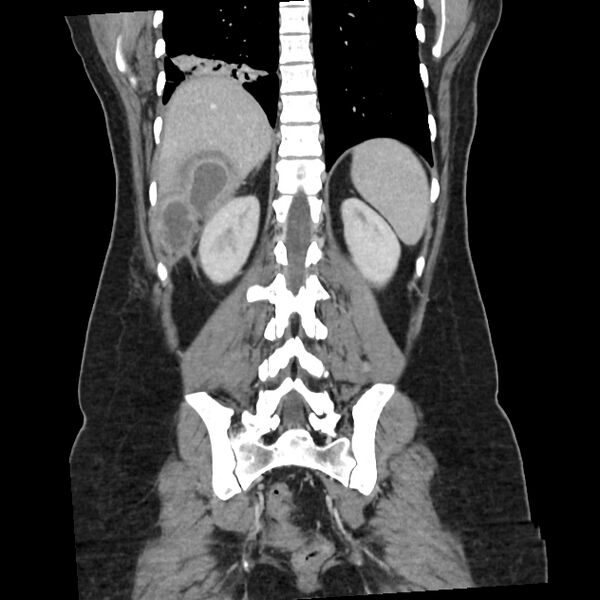 File:Ascending retrocecal appendicitis with liver abscesses (Radiopaedia 60066-67615 C 5).jpg