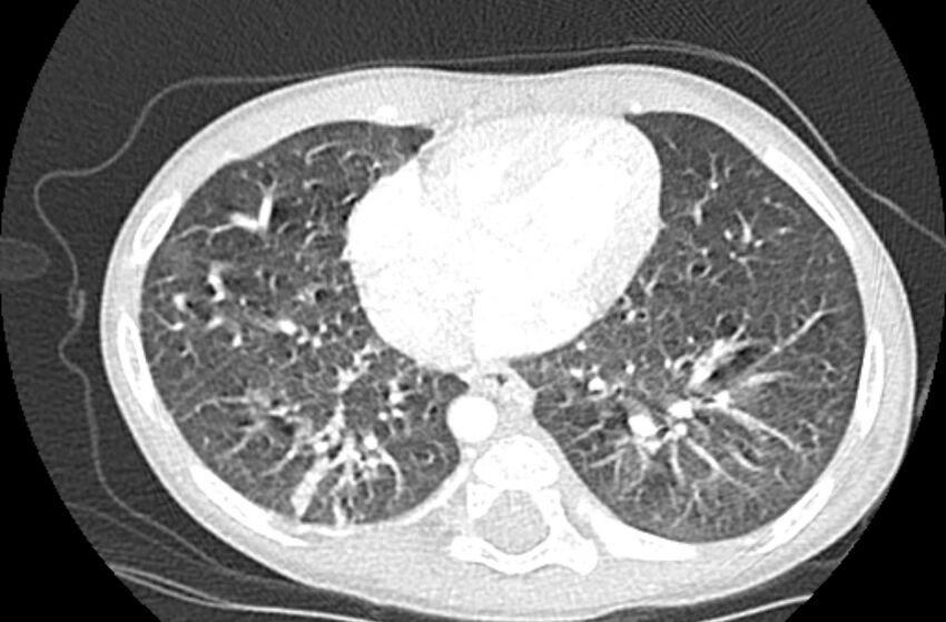 Asplenia syndrome (Radiopaedia 73083-83792 Axial lung window 51).jpg