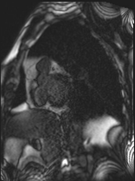 File:Asymmetric septal hypertrophic cardiomyopathy - systolic anterior motion of mitral leaflet (Radiopaedia 72795-83445 D 3).jpg