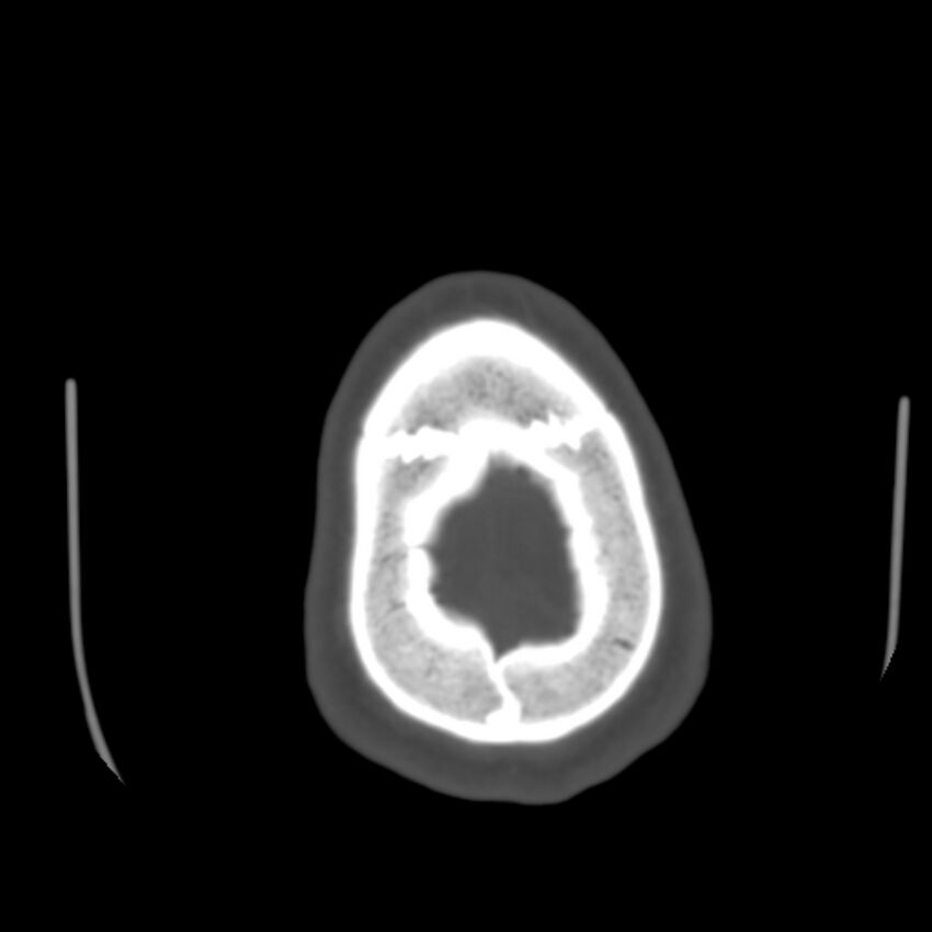Asymptomatic occipital spur (Radiopaedia 87753-104201 Axial bone window 202).jpg