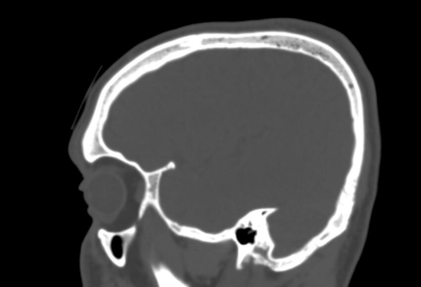 Asymptomatic occipital spur (Radiopaedia 87753-104201 Sagittal bone window 64).jpg