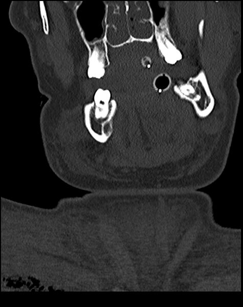 File:Atlanto-occipital dissociation - Traynelis type 1 (Radiopaedia 87570-103948 Coronal bone window 1).jpg