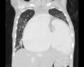 Atrial septal defect complicated by Eisenmenger syndrome (Radiopaedia 53707-59768 Sagittal lung window 9).jpg