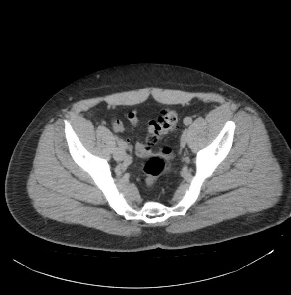 File:Atrophic kidney due to severe chronic obstructive hydronephrosis (Radiopaedia 40828-43474 Axial non-contrast 38).jpg
