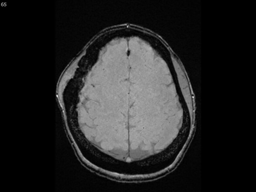 Atypical meningioma - intraosseous (Radiopaedia 64915-74572 Axial SWI 65).jpg