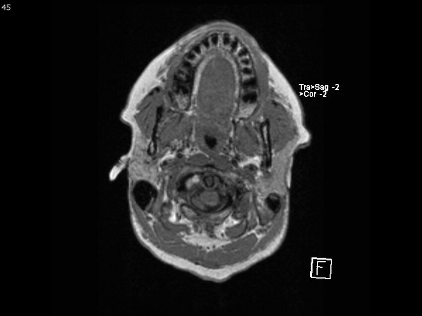 Atypical meningioma - intraosseous (Radiopaedia 64915-74572 Axial T1 45).jpg