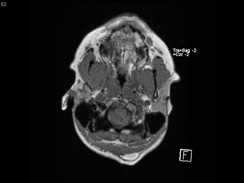Atypical meningioma - intraosseous (Radiopaedia 64915-74572 Axial T1 52).jpg