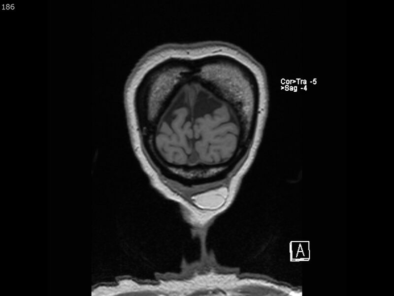 File:Atypical meningioma - intraosseous (Radiopaedia 64915-74572 Coronal T1 186).jpg