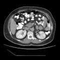 Atypical retroperitoneal lymphocoeles with large leiomyoma of uterus (Radiopaedia 32084-33024 A 16).jpg