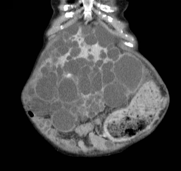 File:Autosomal dominant polycystic kidney disease (Radiopaedia 16777-16490 B 5).jpg