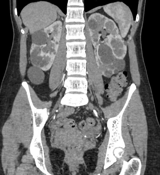 File:Autosomal dominant polycystic kidney disease - early onset (Radiopaedia 40734-43387 C 1).jpg