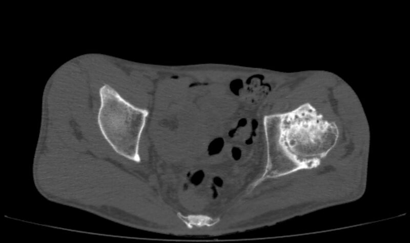 File:Avascular necrosis of the left hip (Radiopaedia 75068-86125 Axial bone window 27).jpg