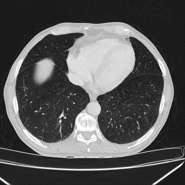 File:Azygos lobe (Radiopaedia 38259-40275 Axial lung window 61).jpg