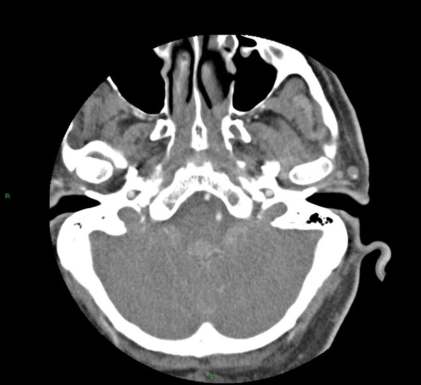 Basal ganglia hemorrhage (Radiopaedia 58763-65985 D 35).jpg